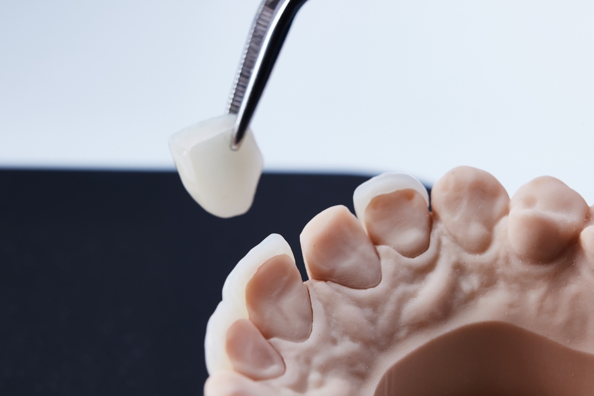 Veneers in Waldkraiburg – Keramik-Veneers für Frontzähne in der Zahnarztpraxis Helena Brodt